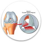 Rotura de meniscos y ligamentos cruzados