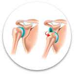 Inestabilidad de hombro