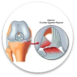 Rotura de meniscos y ligamentos cruzados