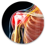 Neuropatías compresivas del brazo